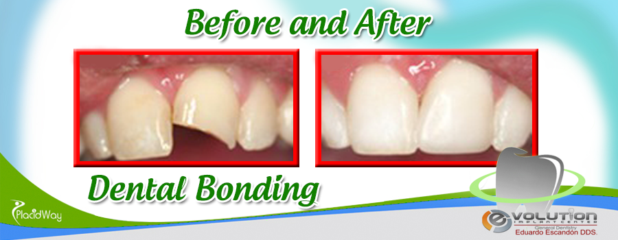 Dental Bonding Before and After Results in Mexico at Evolution Implant Center