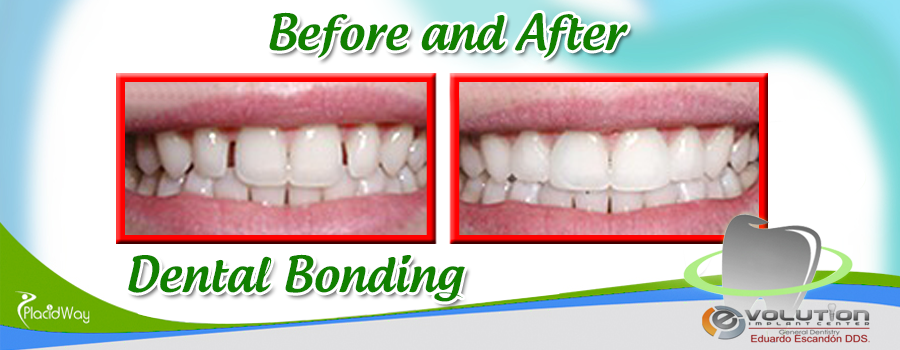 Before and After Dental Bonding at Evolution Implant Center, Mexico