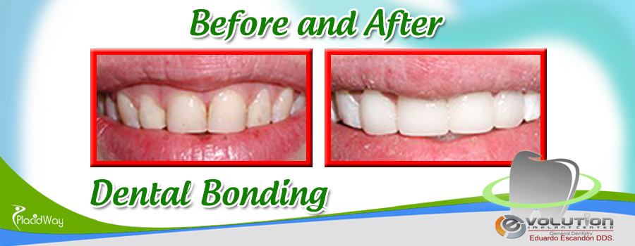 Dental Bonding Image Before and After in Los Algodones, Mexico