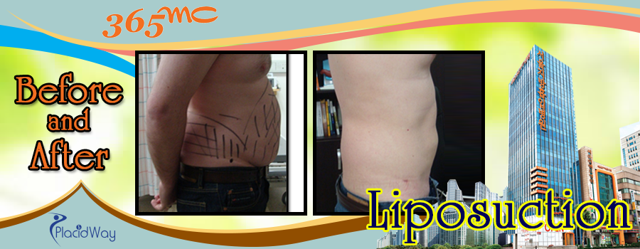Liposuction Procedure in South Korea Before and After Images