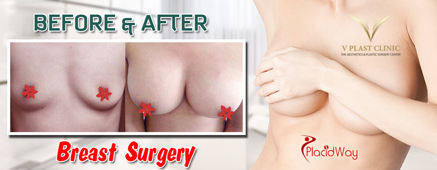 Before and After Images Breast Surgery Thailand