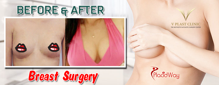 Breast Surgery Before and After V Plast Clinic in Thailand