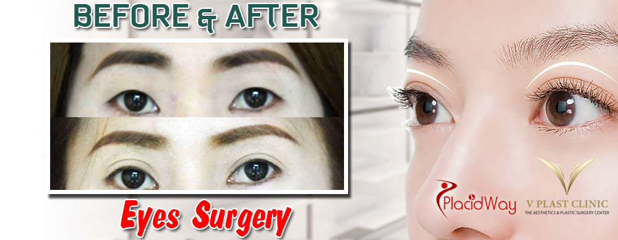 Before and After Images Eyelid Surgery Thailand