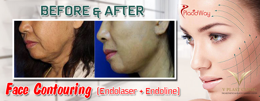 Before and After Face Contouring Surgery in Thailand