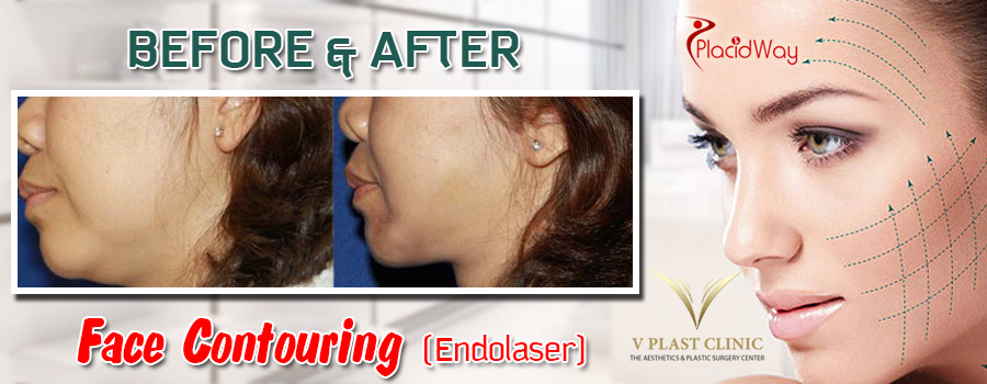 Before and After Face Contouring Surgery in Thailand