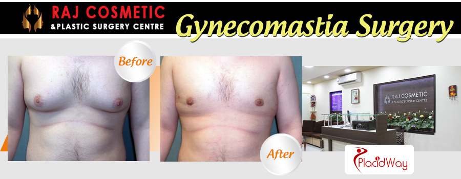 Before and After Images Gynecomastia Surgery India