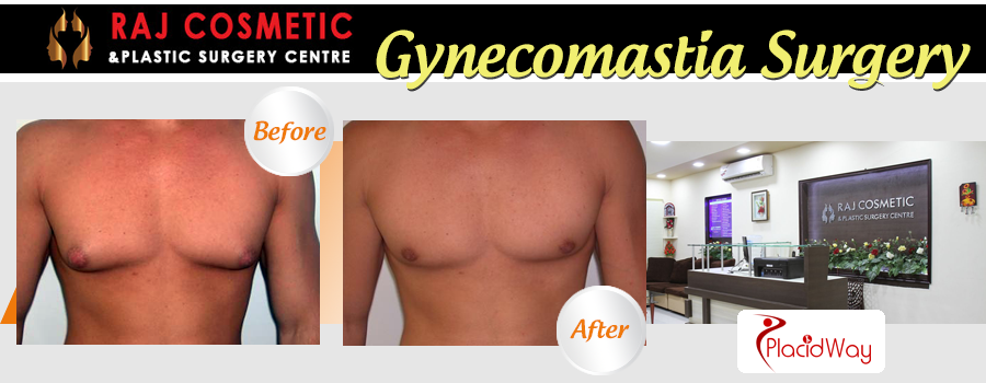 Gynecomastia Surgery Before and After Raj Cosmetic India