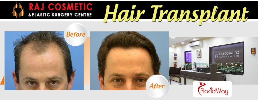 Before and After Images Hair Transplant India