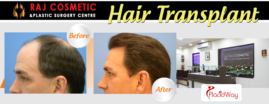 Hair Transplant Before and After Raj Cosmetic India