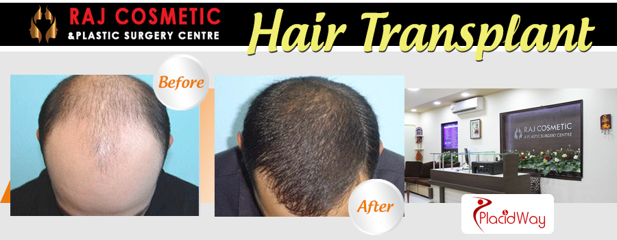 Raj Cosmetic and Plastic Surgery Centre Before and After Hair Transplant 