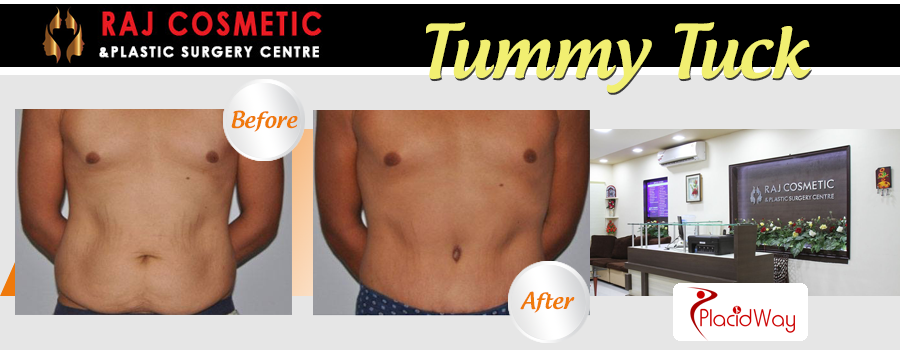 Before and After Images Tummy Tuck Surgery India
