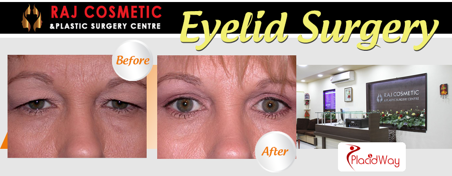Before and After Images Eyelid Surgery India