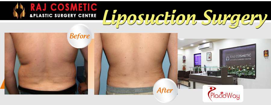 Before and After Images Liposuction Surgery India