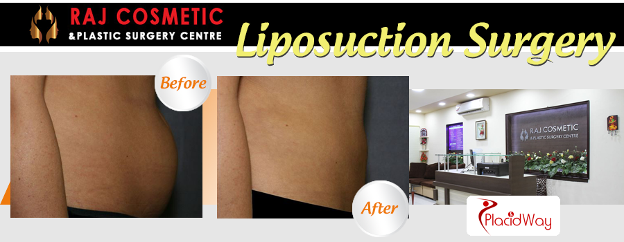Liposuction Surgery Before and After Raj Cosmetic India