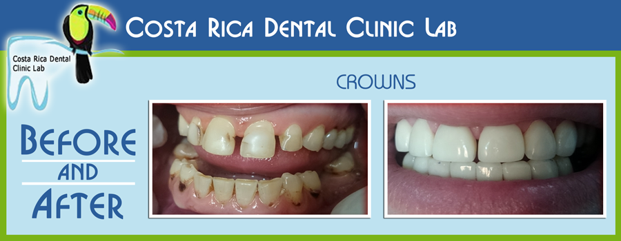 Before and After Dental Crowns - Costa Rica
