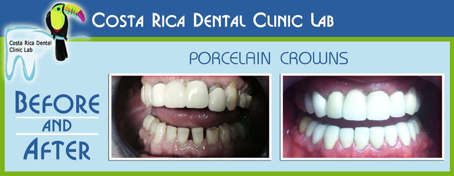 Porcelain Crowns Before and After Costa Rica Dental Clinic Lab