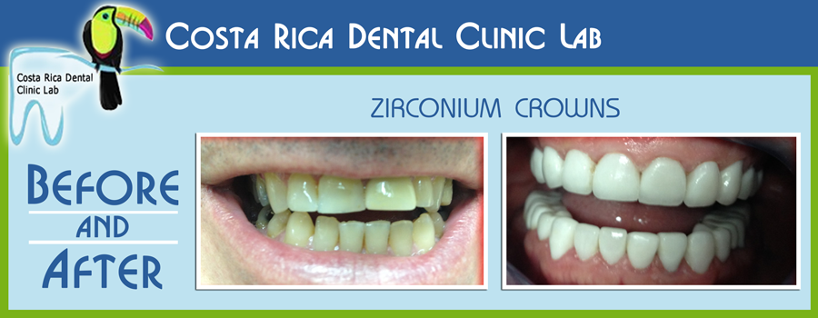 Costa Rica Dental Clinic Lab Before and After Zirconium Crowns