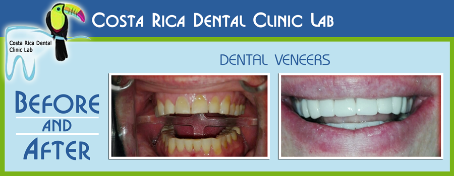 Before and After Dental Veneers - Costa Rica Dental Clinic Lab