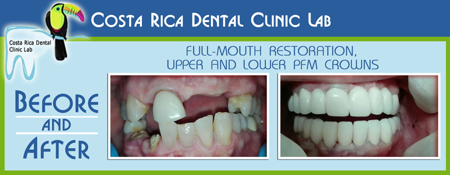 Before and After Full-mouth Restoration, Upper and Lower PFM Crowns