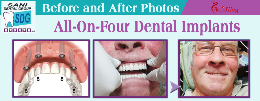 Before and After All-on-Four Dental Implants in Los Algodones, Mexico