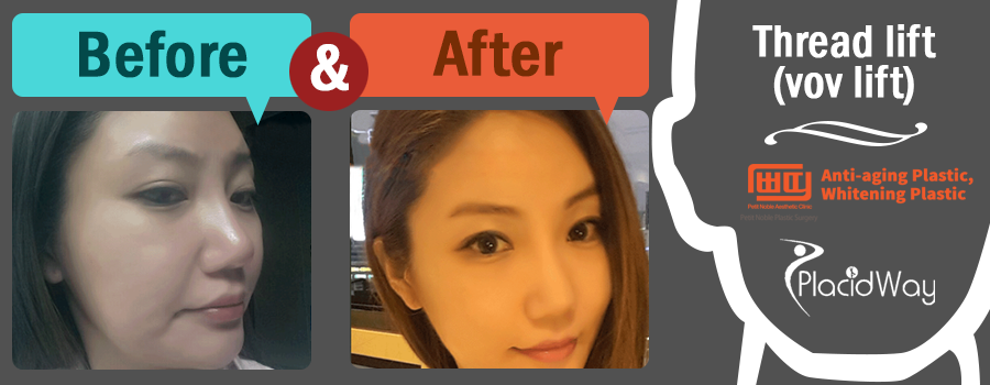Before After Thread Lift - Patient Testimonial - South Korea