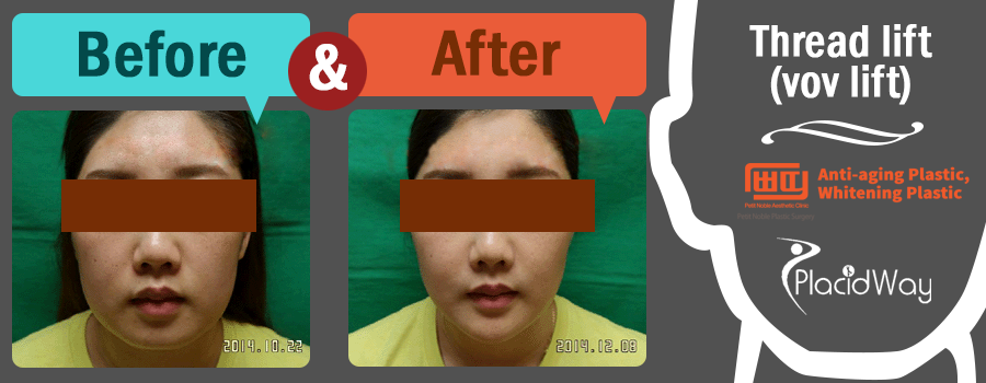 Real Patient Result After Thread Lift in South Korea