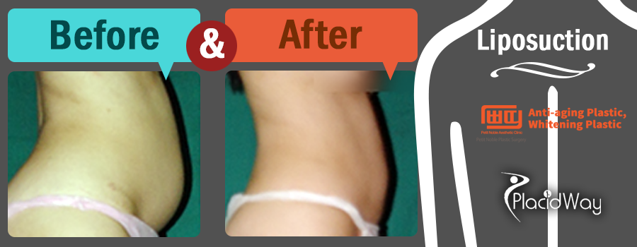 Before After Liposuction - Patient Testimonial - South Korea