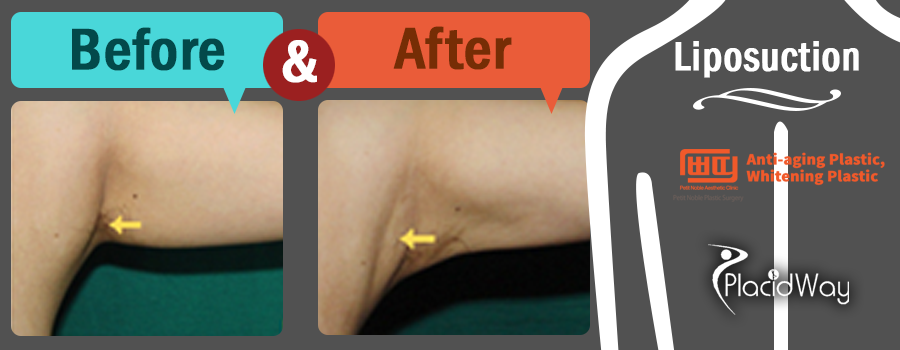 Before and After Liposuction Pictures in South Korea