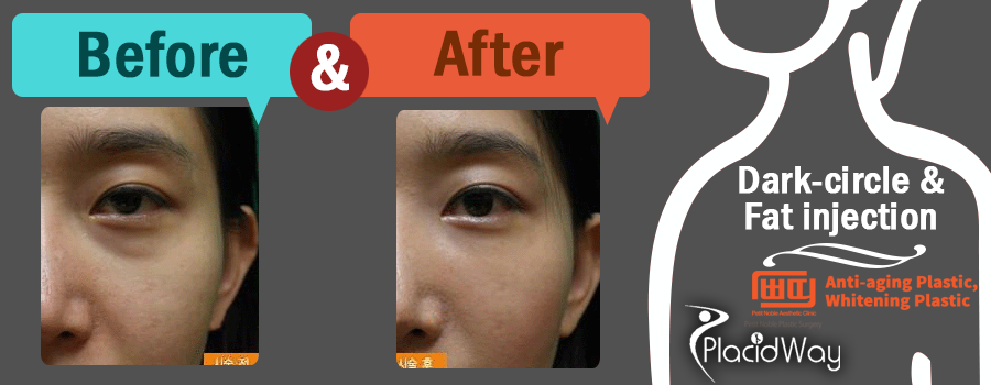 Before After Dark Circle and Fat injection - Patient Testimonial - South Korea