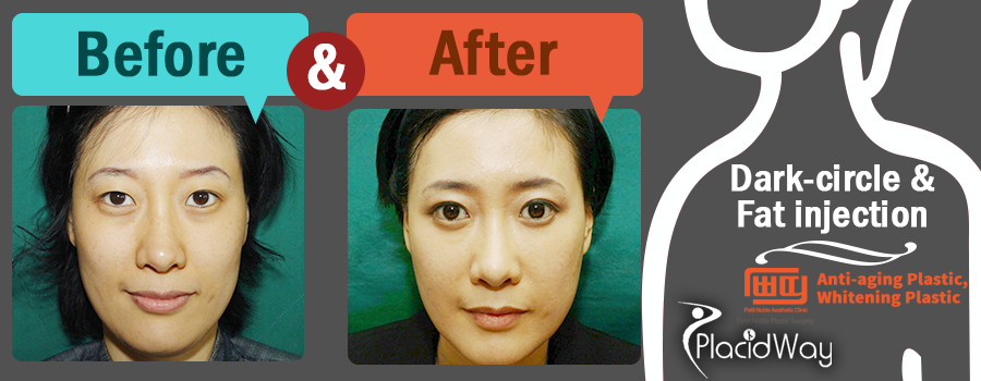 Before and After Dar Circle and Fat Injection Pictures in South Korea