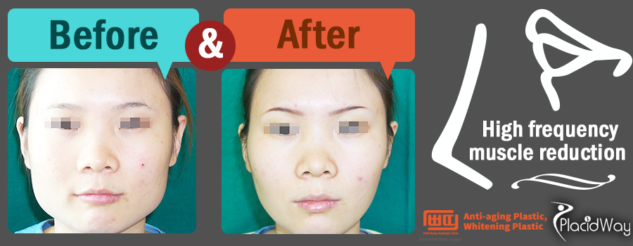 Before After High frequency muscle reduction - Patient Testimonial - South Korea