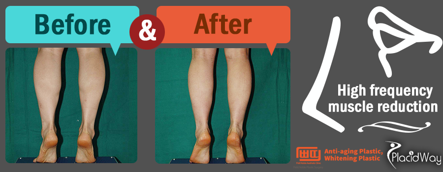 Before and After High frequency muscle reduction Pictures in South Korea