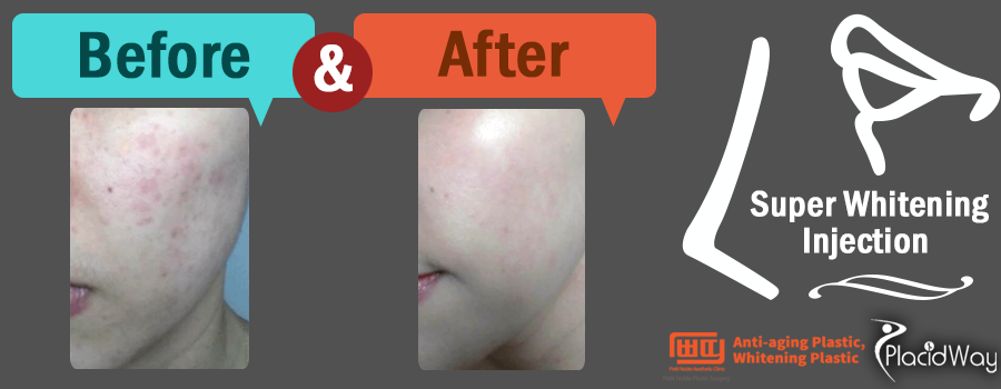 Real Patient Result After Super Whitening Injection in South Korea