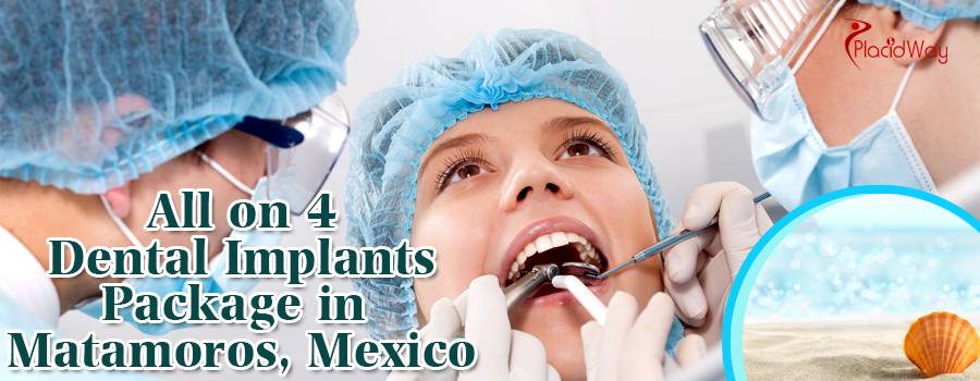 All on 4 Dental Implants in Matamoros, Mexico