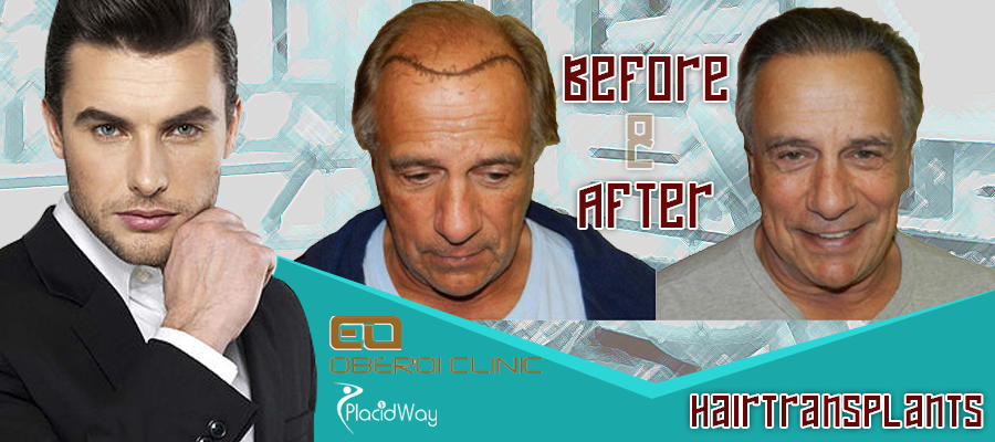 Before and After Hair Transplant Procedure in Belgium