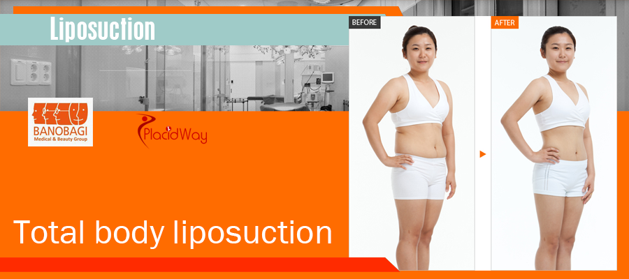 Full body liposuction in Seoul South Korea