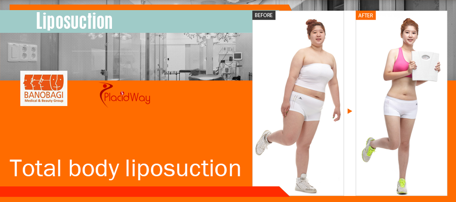 Liposuction Surgery in Seoul, South Korea