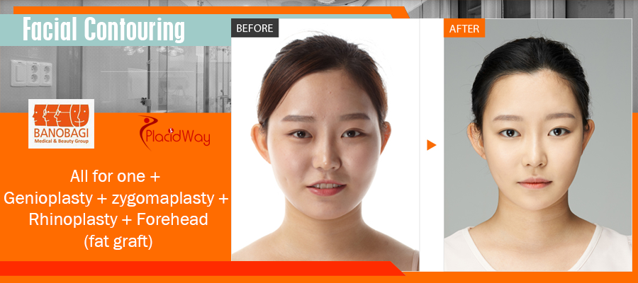 Facial Contouring (Banobagi Plastic Surgery Center) in Seoul, South Korea