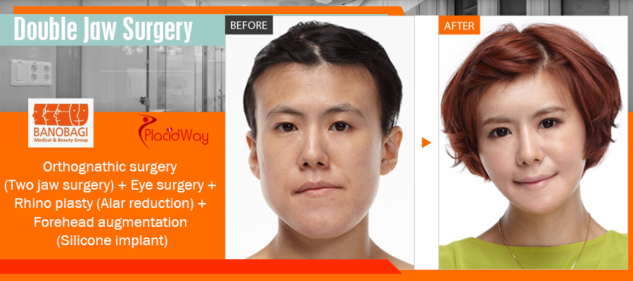 korean plastic surgery before and after jaw