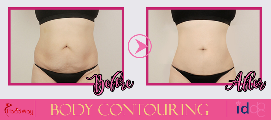 Body Contouring Procedure Before and After South Korea