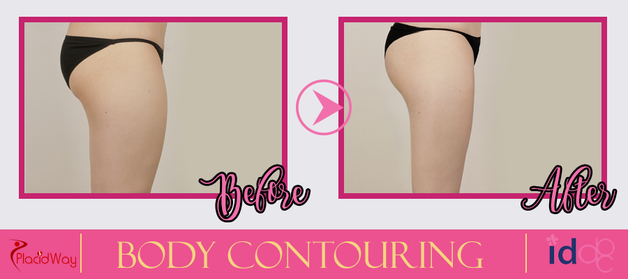 Body Contouring Before and After Picture in South Korea