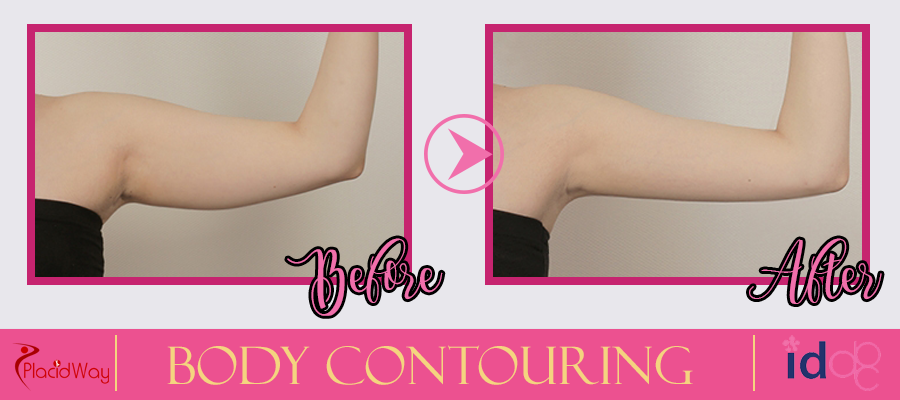 Patient Testimonial Body Contouring Surgery in Seoul, South Korea