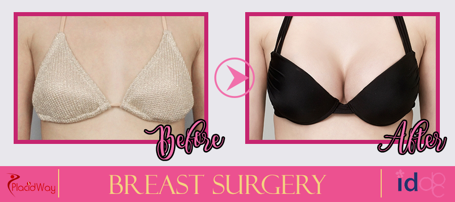Breast Surgery Procedure Before and After South Korea