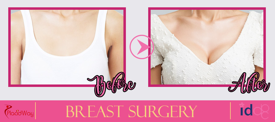 Breast Augmentation Before and After Picture in South Korea