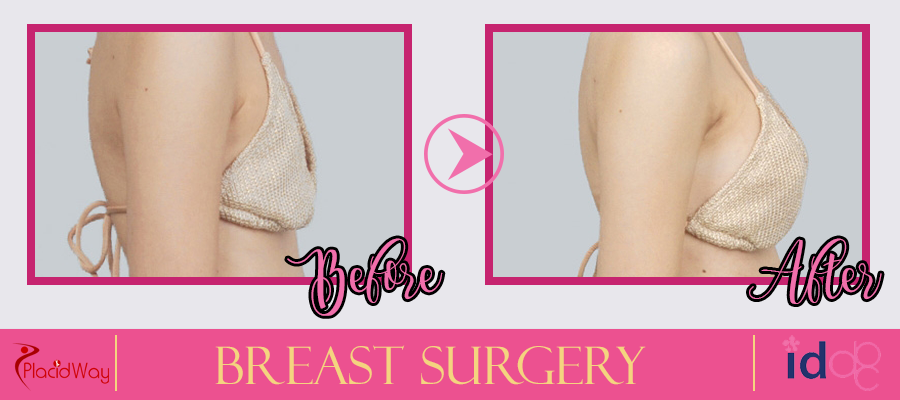 Patient Testimonial Breast Surgery in Seoul, South Korea