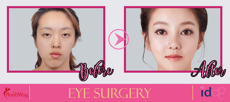 Eye Surgery Before and After South Korea