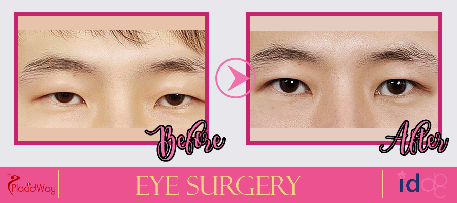 Eye Surgery Before and After Picture in Seoul South Korea
