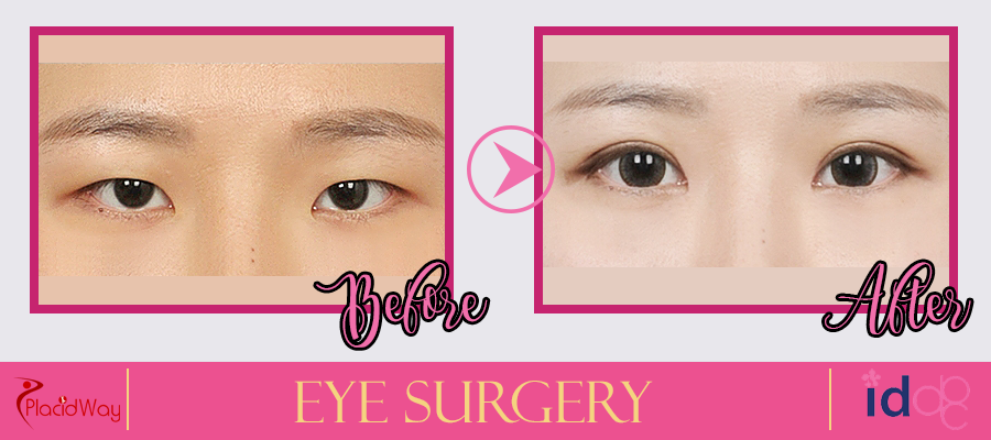 Patient Testimonial Eye Surgery in Seoul, South Korea