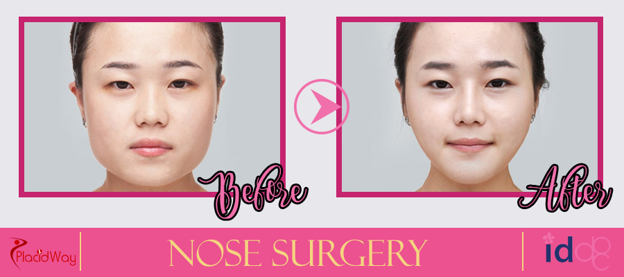 Nose Procedure Before and After South Korea