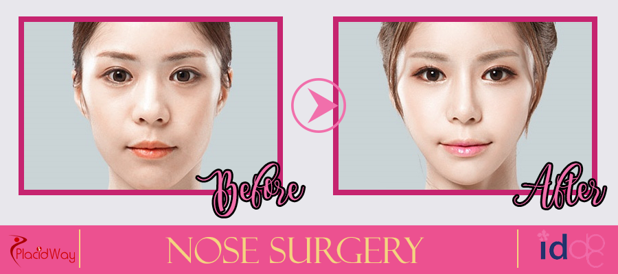 Nose Surgery Before and After Picture in South Korea